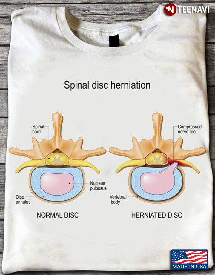Spinal Disc Herniation Disease Health