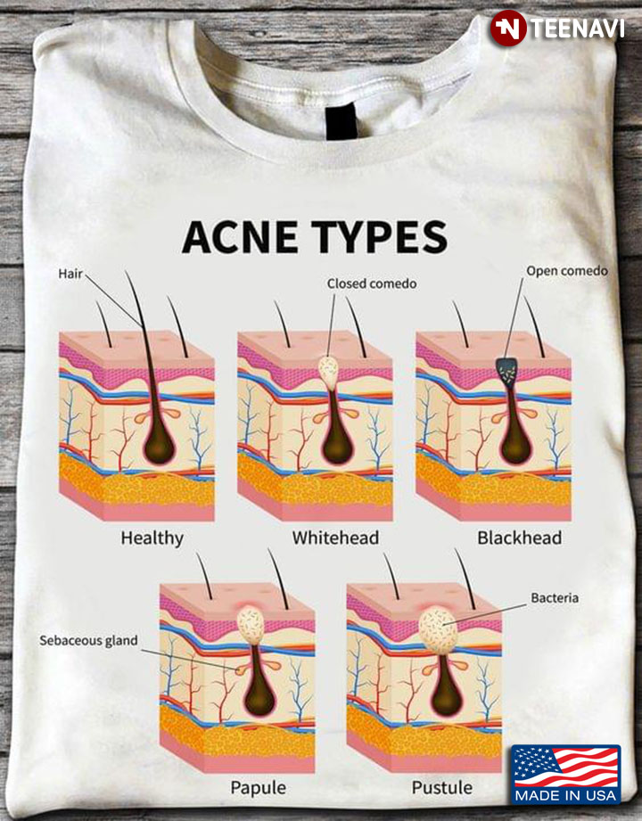 Acne Types Pimple Skin Diseases Anatomy Medical Diagram