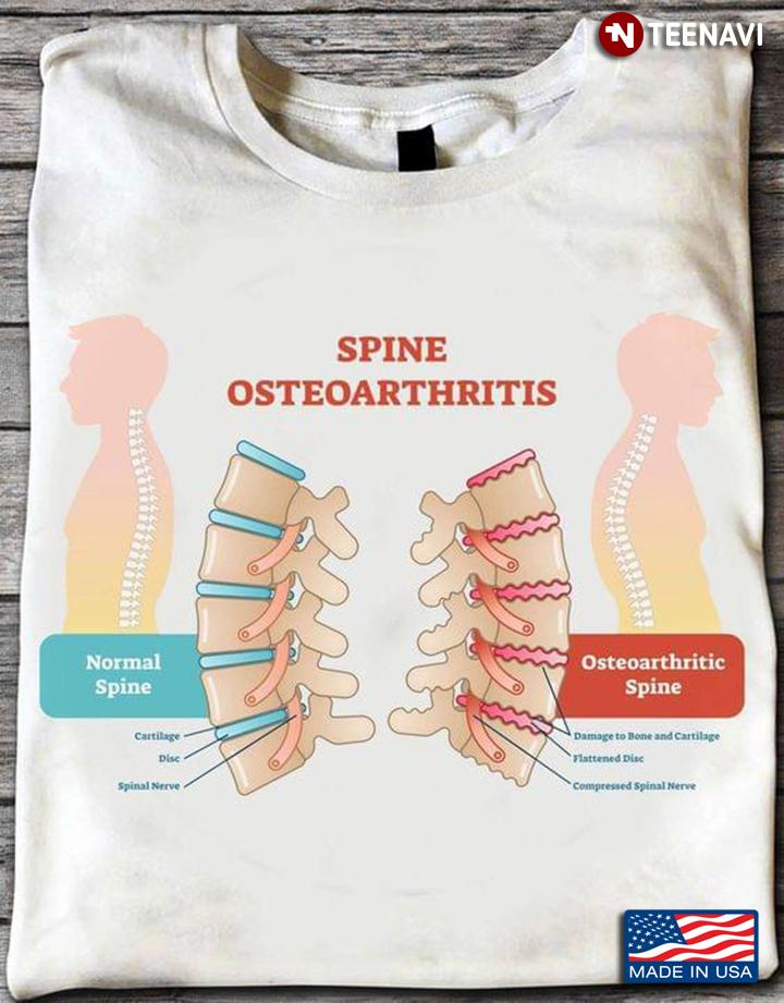 Spine Osteoarthritis Anatomy Normal Spine and Osteoarthritic Spine