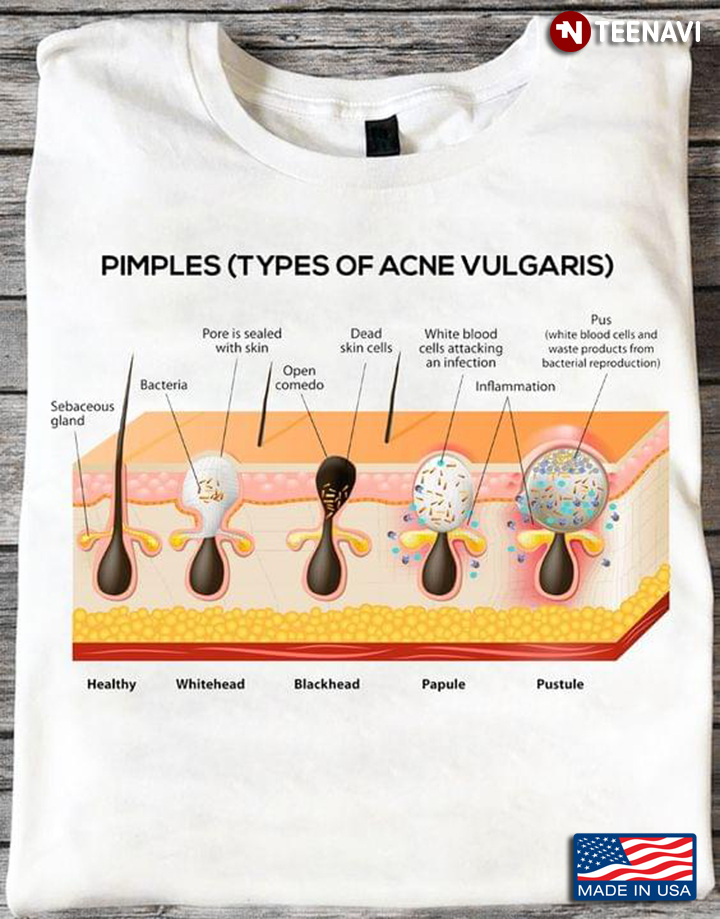 Pimples Types Of Acne Vulgaris