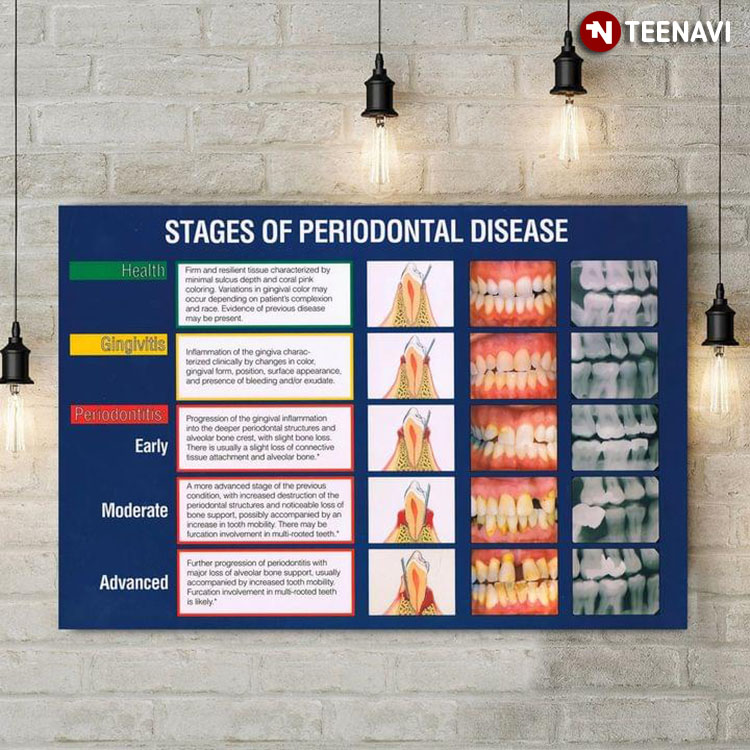 Dentist Stages Of Periodontal Disease